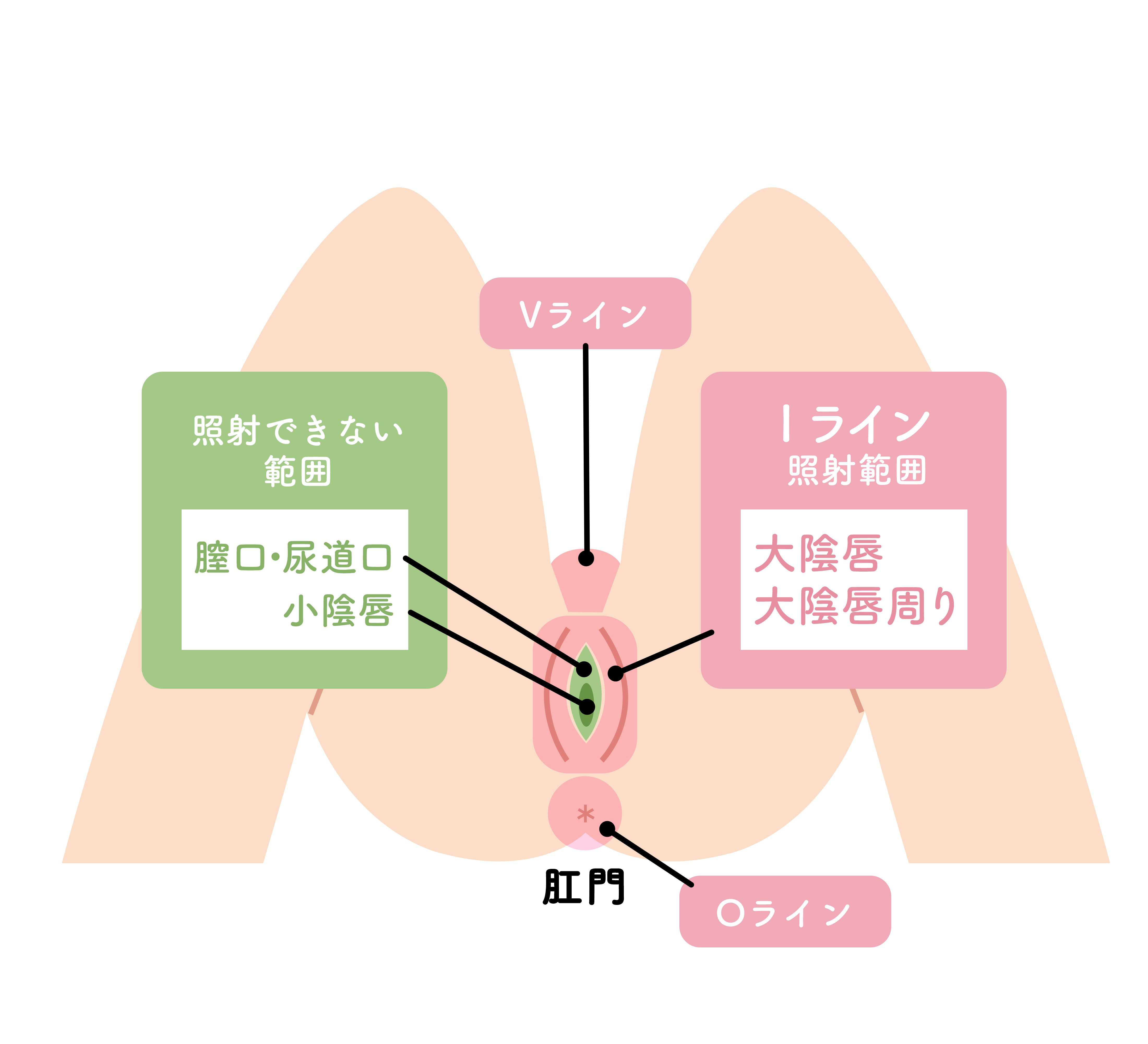 Iラインの脱毛 料金 医療レーザー脱毛なら東京イセアクリニック