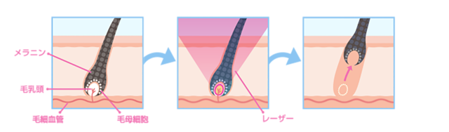 医療脱毛メカニズム