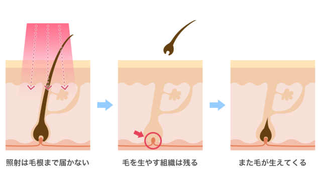 エステ脱毛メカニズム