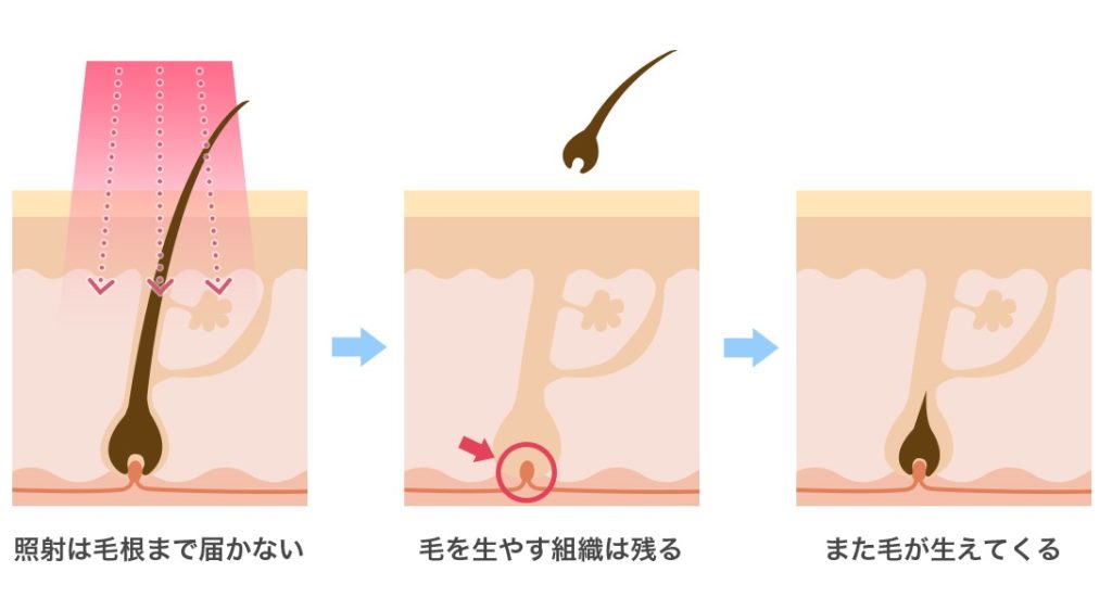 エステ脱毛の仕組み