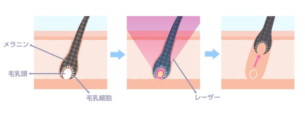 医療脱毛の仕組み