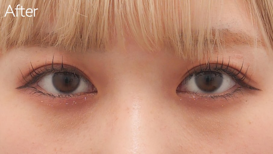 埋没法症例After