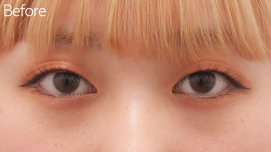 埋没法症例Before