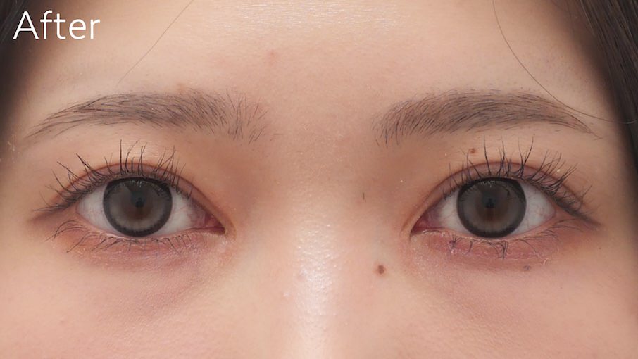 目頭切開症例After