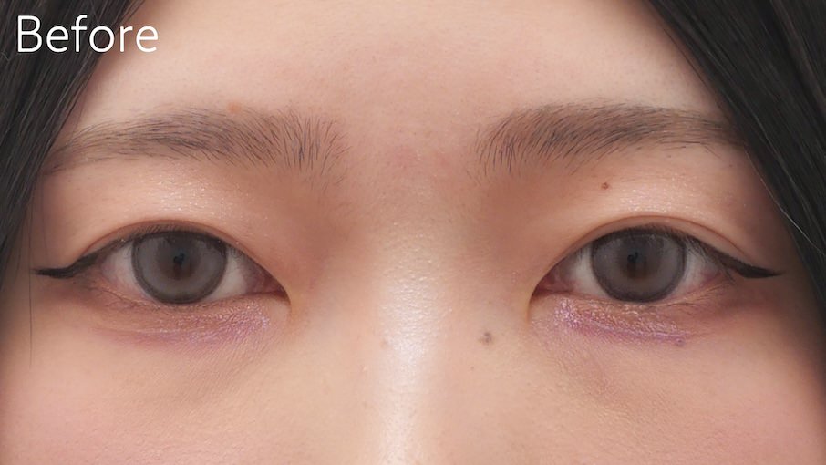 目頭切開症例Before