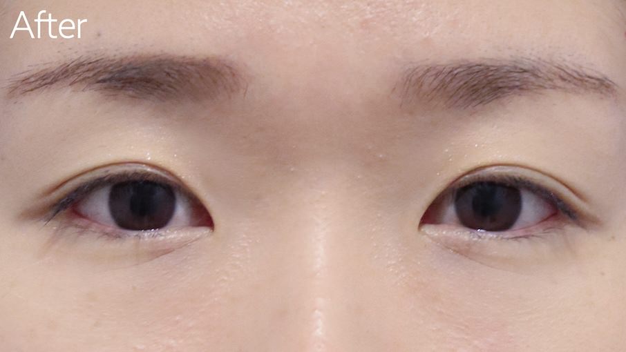 目尻切開症例After