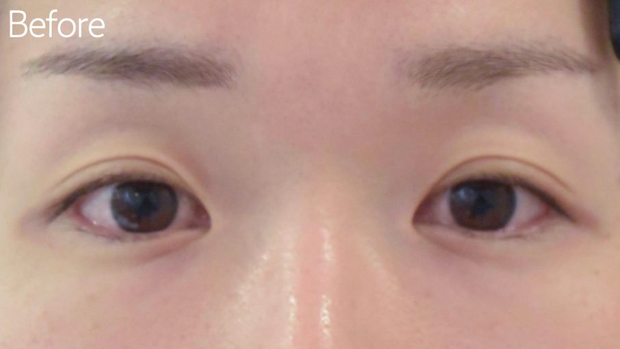目尻切開症例Before