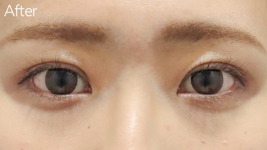 小切開法症例After