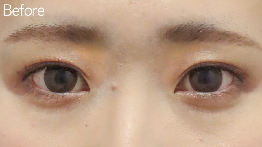 小切開法症例Before