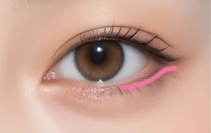 たれ目形成(下眼瞼下制術)