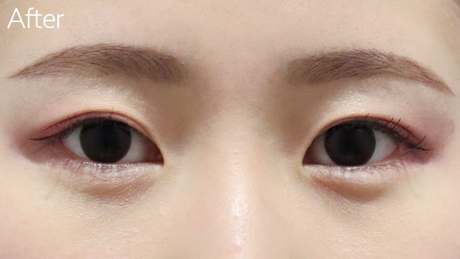 たれ目形成(下眼瞼下制術)症例After