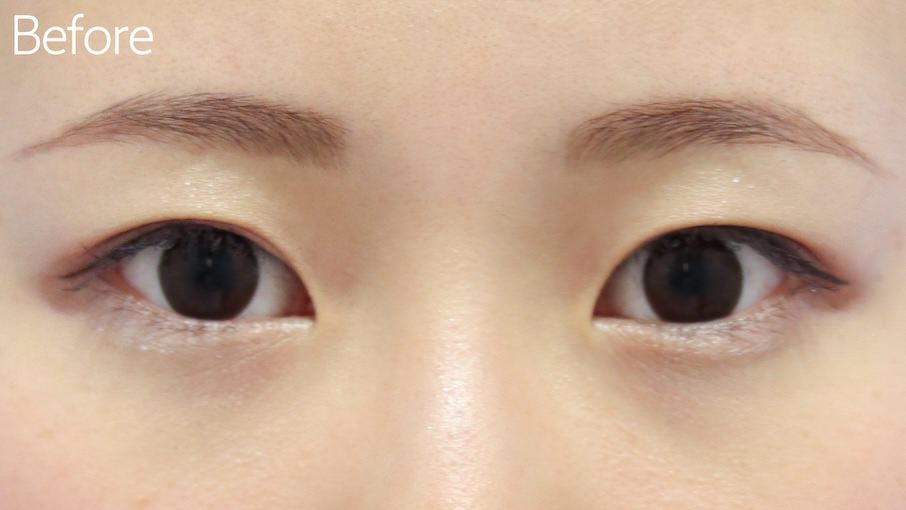 たれ目形成(下眼瞼下制術)症例Before