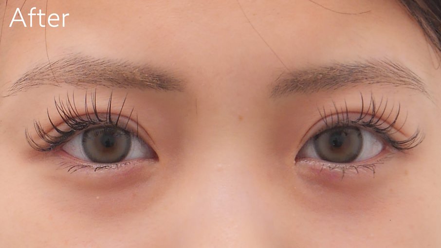 全切開法症例After