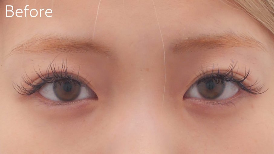 全切開法症例Before