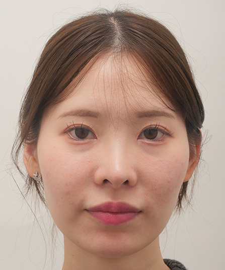 セットプラン症例After