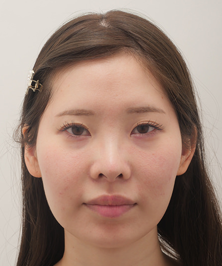 セットプラン症例Before