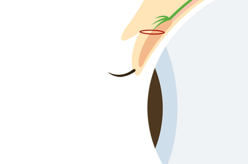 まぶたの脂肪取りの施術方法3