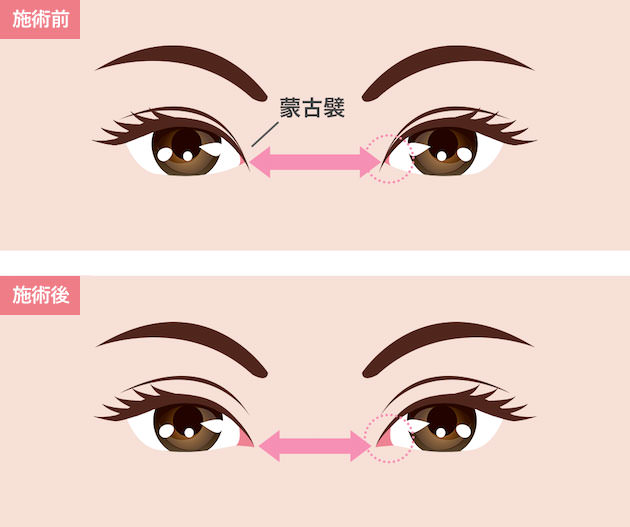 目頭切開