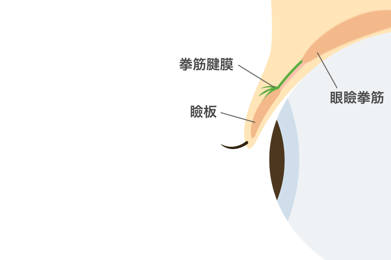 小切開法の手術方法1