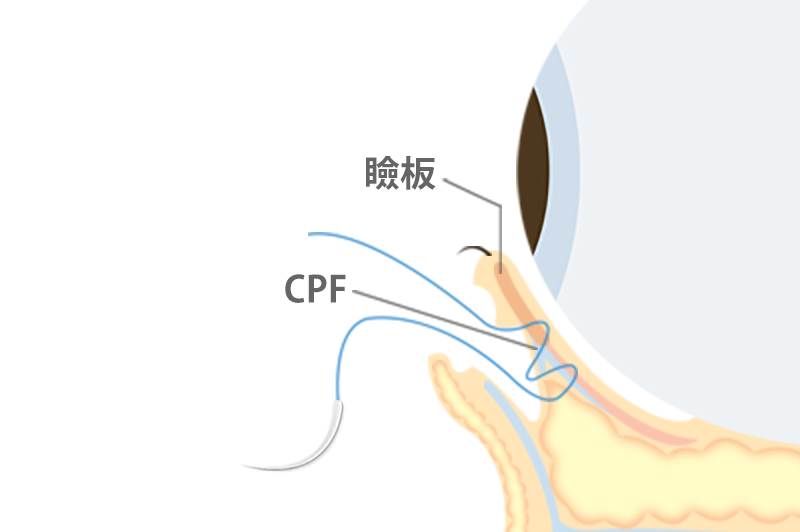 タレ目形成の手術方法4