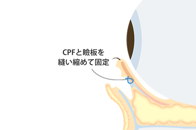 タレ目形成の手術方法5