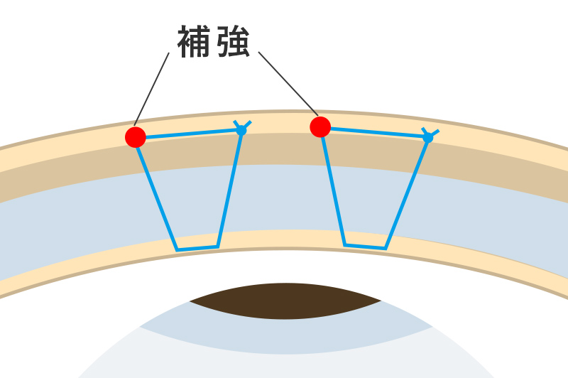 埋没法ダブル