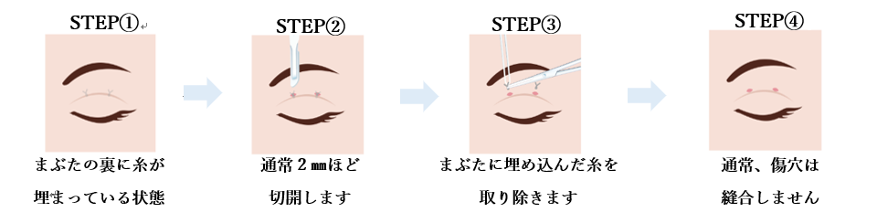 埋没法　抜糸