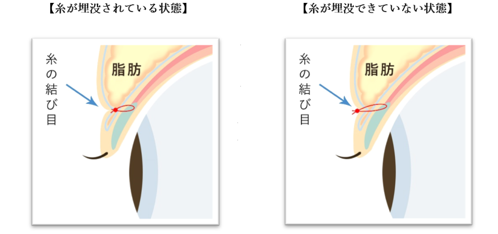 糸の結び目