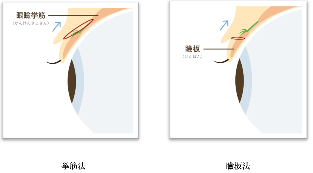 埋没法　術式