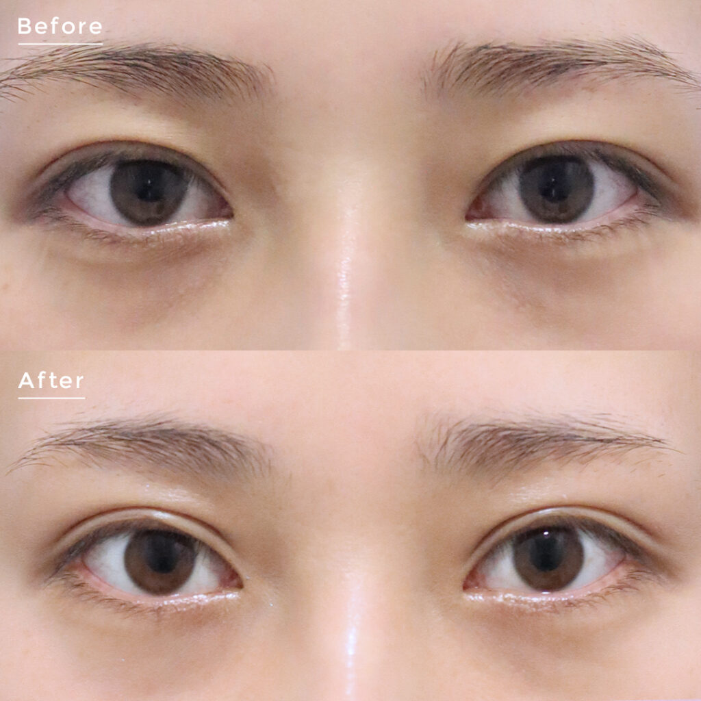 二重整形の埋没法と切開法の違いとは 値段や種類を解説 埋没法 二重整形の基礎知識 東京イセアクリニック