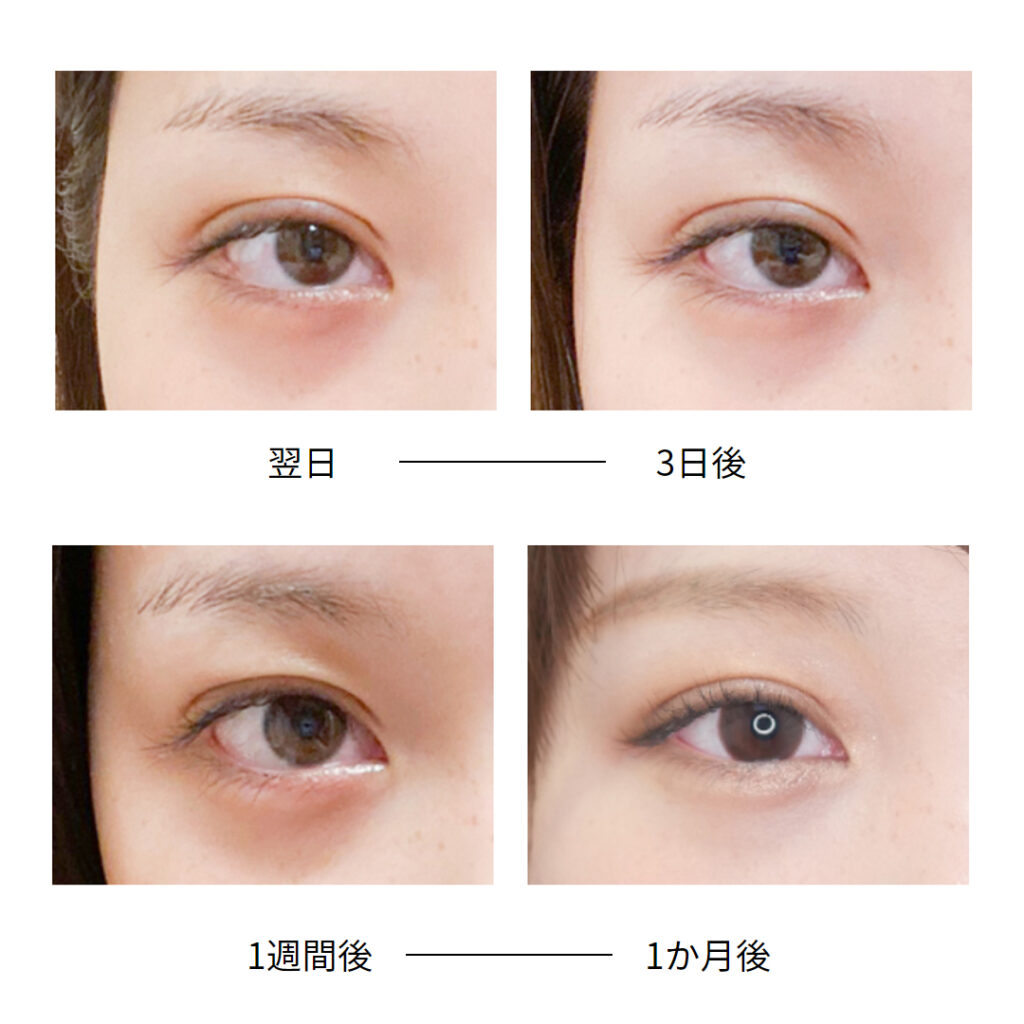 二重整形の埋没法と切開法の違いとは？値段や種類を解説 埋没法・二重整形の基礎知識 東京イセアクリニック