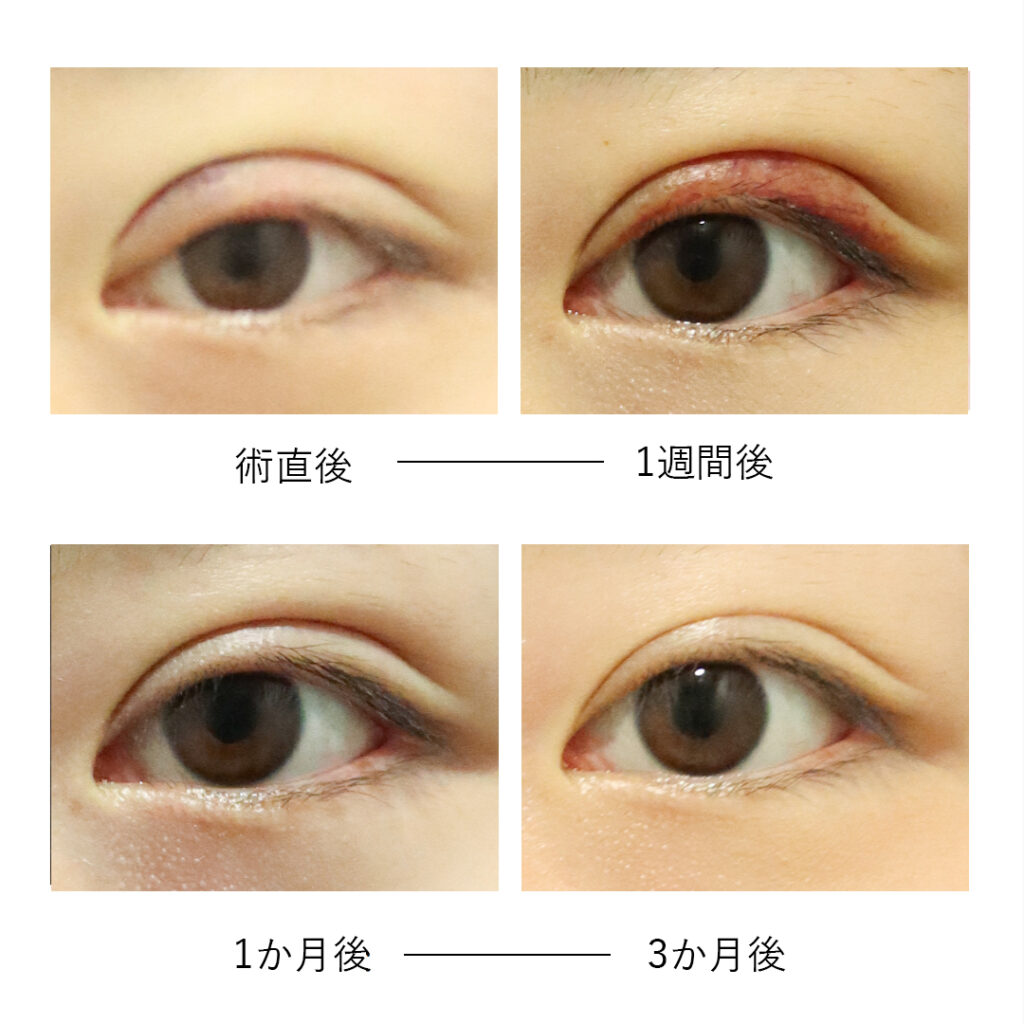 二重整形の埋没法と切開法の違いとは？値段や種類を解説 埋没法・二重整形の基礎知識 東京イセアクリニック