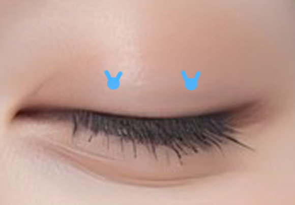 切開法との違い