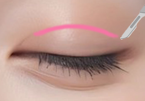 切開法との違い