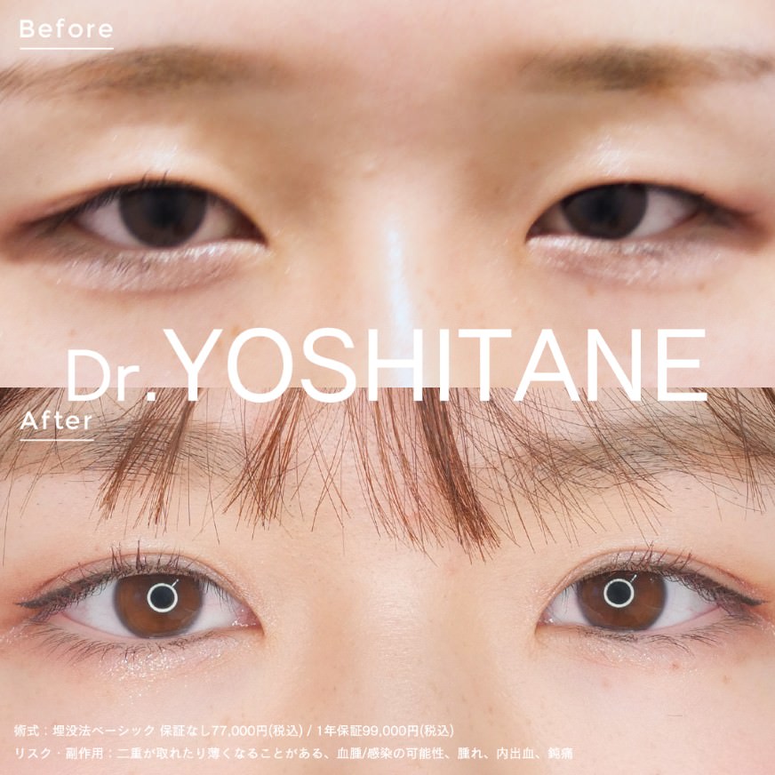 埋没法ベーシック