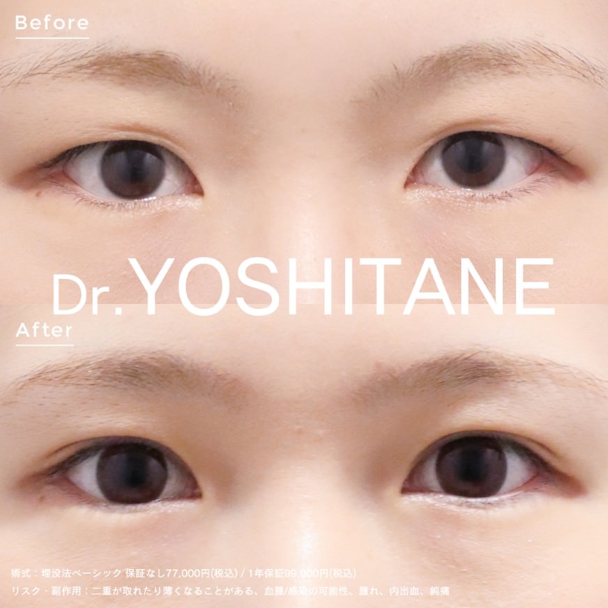 埋没法ベーシック