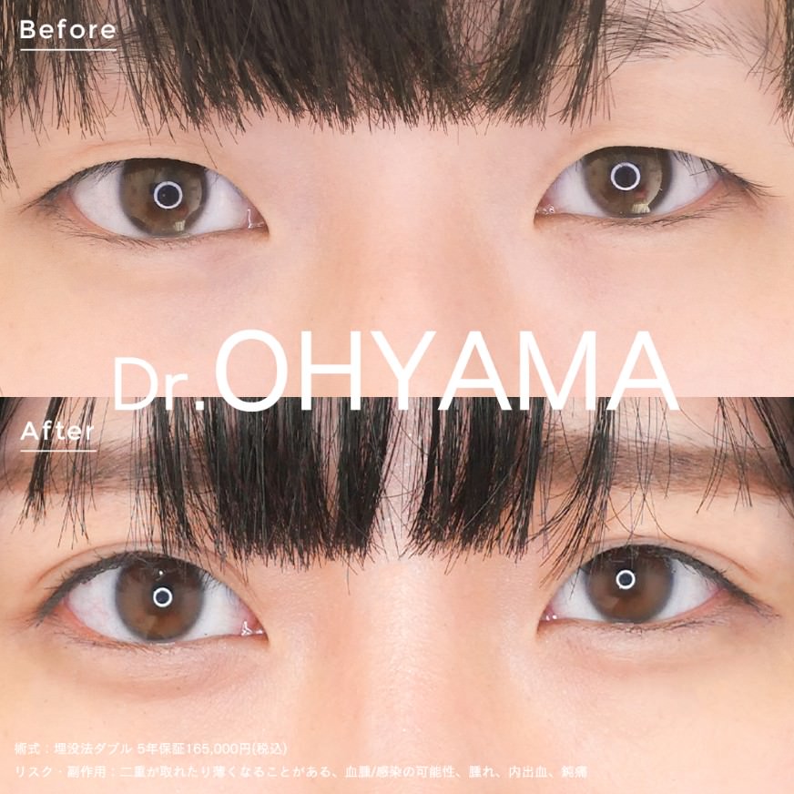 埋没法ダブル症例