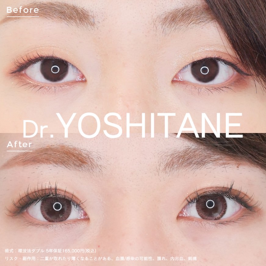 埋没法ダブル症例