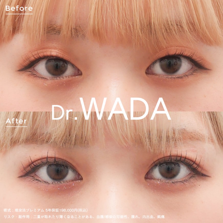 埋没法プレミアム症例