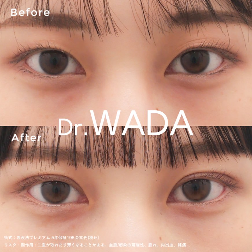 埋没法プレミアム症例