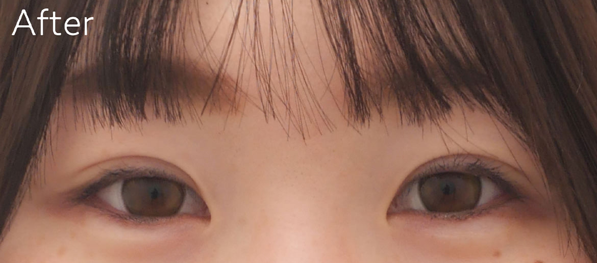 埋没法の他院修正 術後