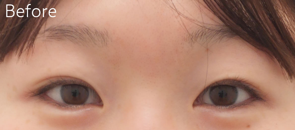 埋没法の他院修正 術前