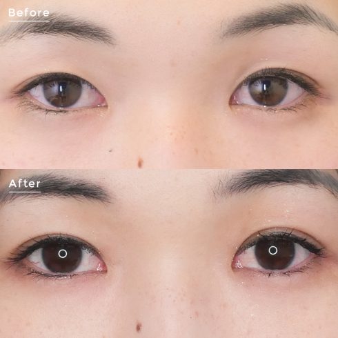 目元の整形 埋没法ダブル 症例写真