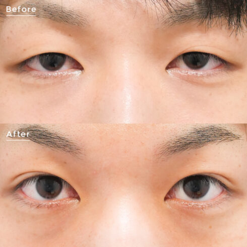 目元の整形 男性症例 症例写真