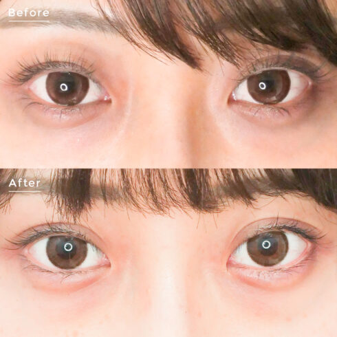 目元の整形 埋没法プレミアム 症例写真