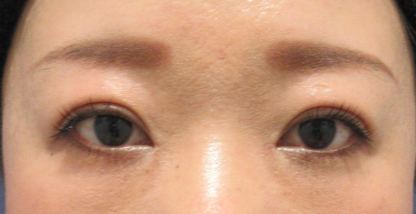 全切開 目頭切開 症例no 737 症例写真 埋没法 二重整形なら東京イセアクリニック 全切開 目頭切開 症例no 737 症例写真 埋没法 二重整形なら東京イセアクリニック