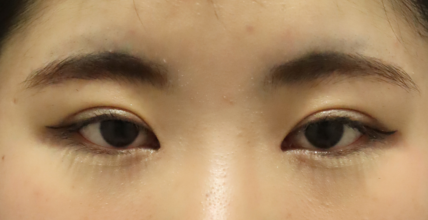 全切開＋目頭切開【症例No.772】 症例写真 埋没法・二重整形なら東京イセアクリニック
