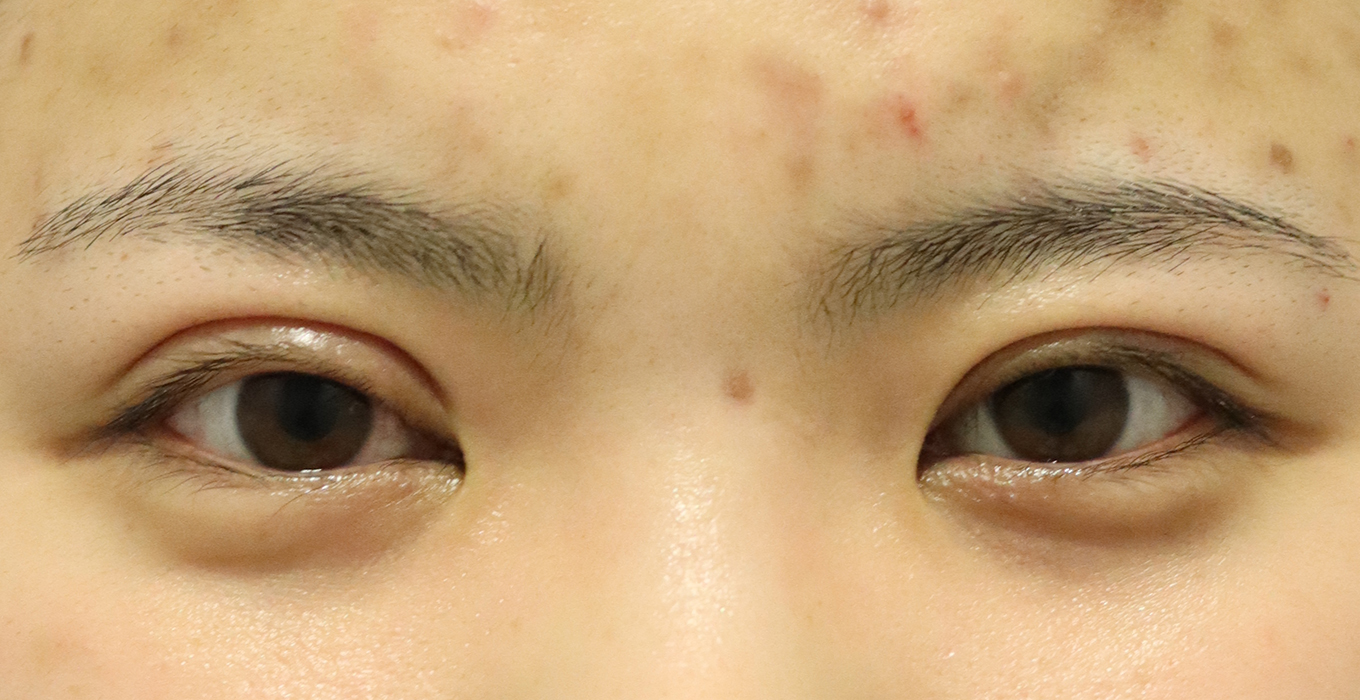 全切開法 症例no 7 症例写真 埋没法 二重整形なら東京イセアクリニック