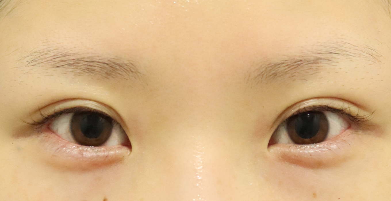 目尻切開 症例写真 埋没法 二重整形なら東京イセアクリニック 目尻切開 症例写真 埋没法 二重整形なら東京イセアクリニック