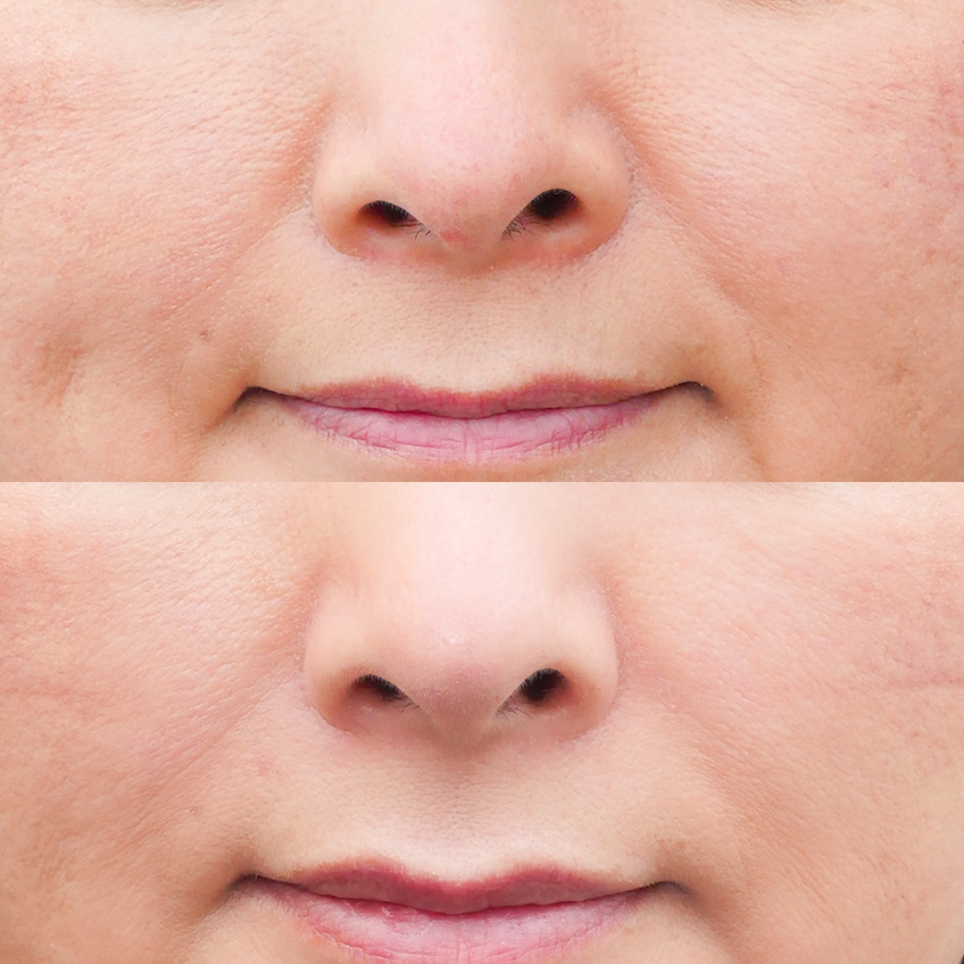 医師が解説 ヒアルロン酸注射はほうれい線に効果があるの ドクターブログ ヒアルロン酸 ボトックス注射 東京 新宿 なら東京イセアクリニック 医師が解説 ヒアルロン酸注射はほうれい線に効果があるの ドクターブログ ヒアルロン酸 ボトックス注射 東京 新宿 なら東京イセアクリニック